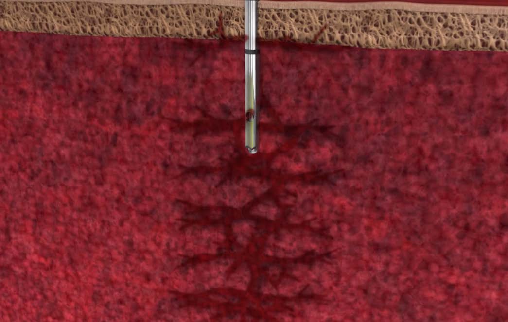 Marrow Cellution closed distal tip with lateral side ports